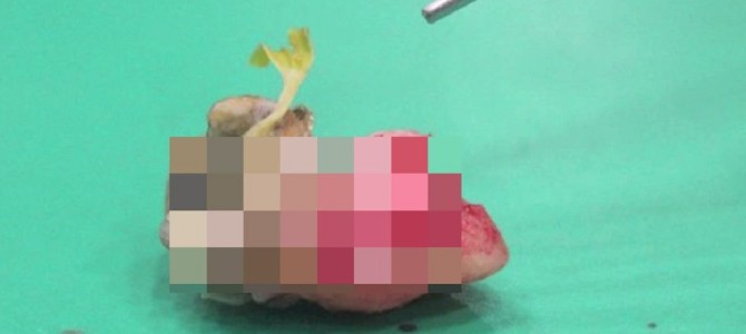 激しい歯痛で病院に行ったら、なんと植物の芽が発芽していた！
