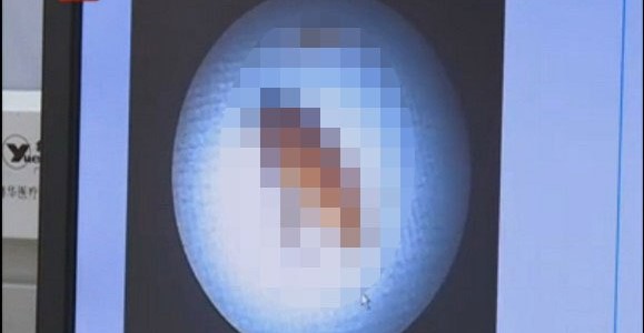 【閲覧注意】3カ月前から鼻血が止まらない→鼻にトンデモなくヤバイモノがいた！？