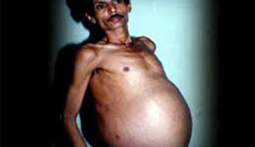 【衝撃】男の腹の中に人間がいた!?　ムンバイの病院で起きた悪夢とは？