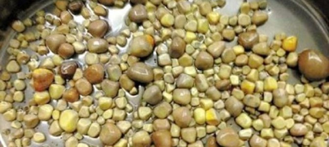 男性の腎臓から420個もの結石を摘出！その原因がなんと○○の食べ過ぎだった