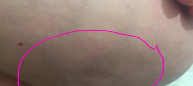 Facebookに驚きの乳がん写真を投稿した女性の思い