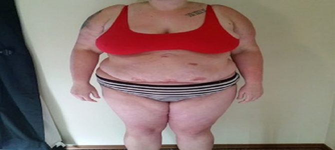 体重１４６ｋｇの女性が１２００万円をかけて大変身した結果